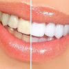 Cách làm trắng răng tại nhà cực hiệu quả