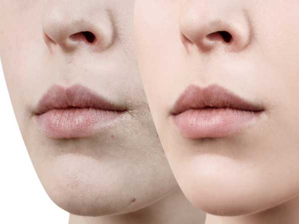 Phụ nữ mang bầu có khử thâm môi được không?