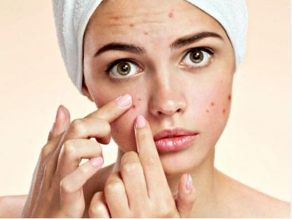Những lý do da mụn cần dùng kem chống nắng